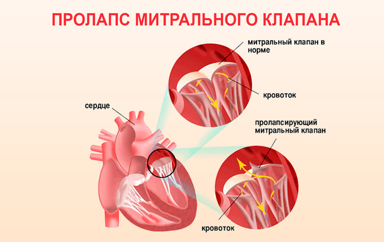 Léčba srdečního prolapsu