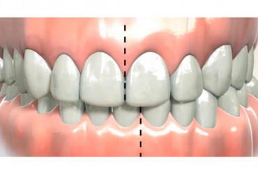 Исправление прикуса