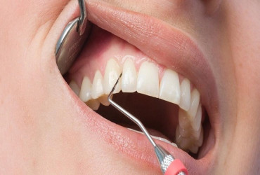 Вестибулопластика