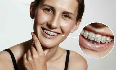 Прозрачные брекеты