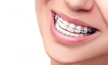 Самолигирующие брекеты