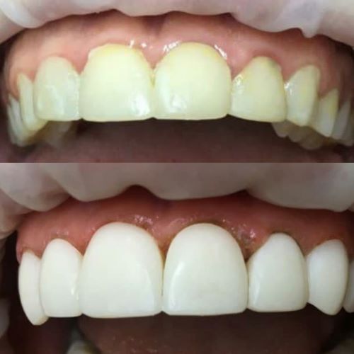 Відбілювання зубів до і після