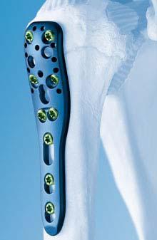 Металостеосинтез в Оксфорд Медікал