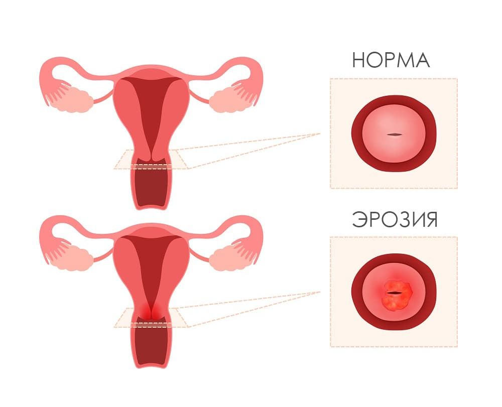  эрозия шейки матки