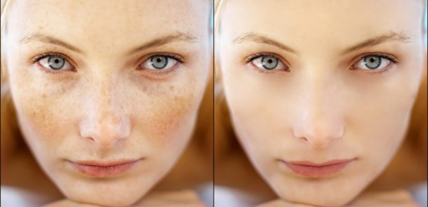 Из-за чего возникает старческая гиперпигментация кожи?
