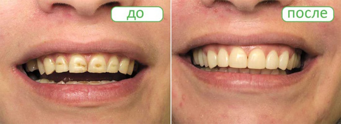 Лікування ерозії зубної емалі 