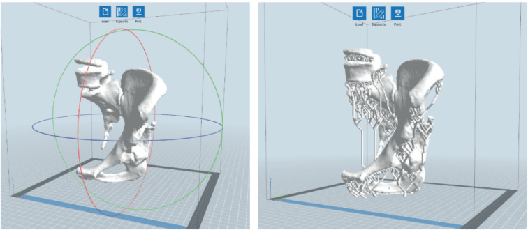 3D-моделирование и предоперационная подготовка в ортопедии
