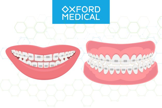  прозорі брекети 