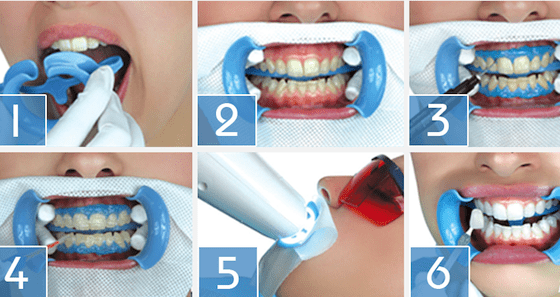 відбілювання зубів системою Вeyond