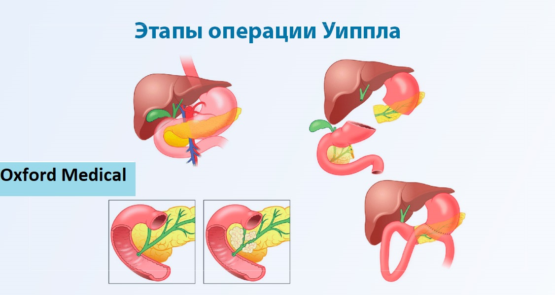 Как проводится панкреатодуоденальная резекция 