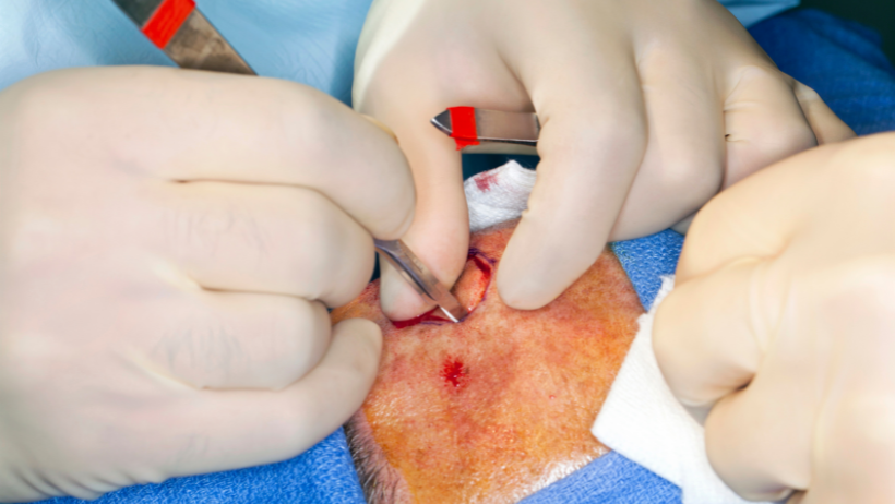 Как проводят удаление меланомы в «Оксфорд Медикал»