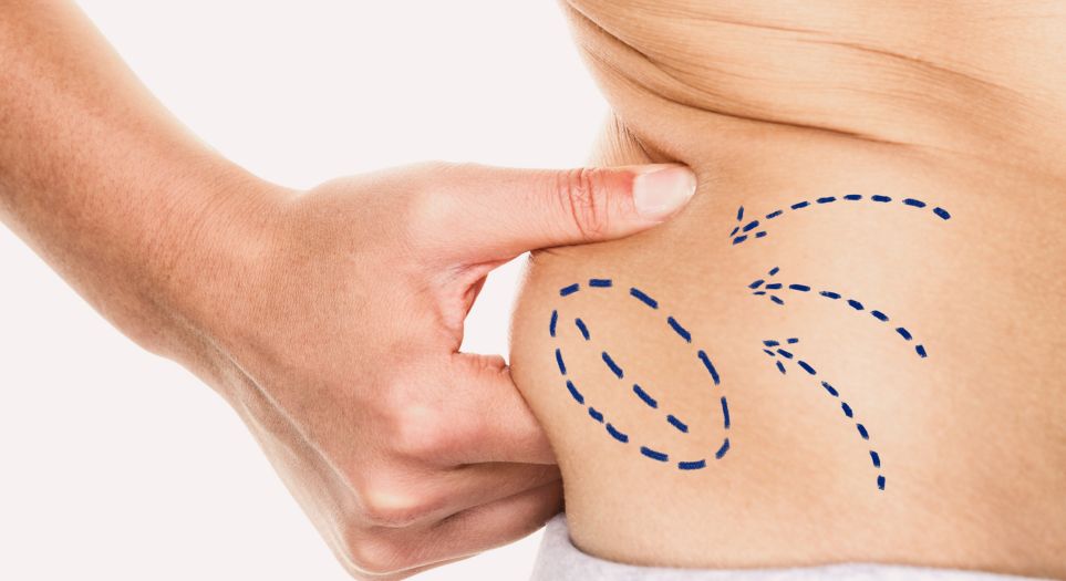 Ліпосакція 1