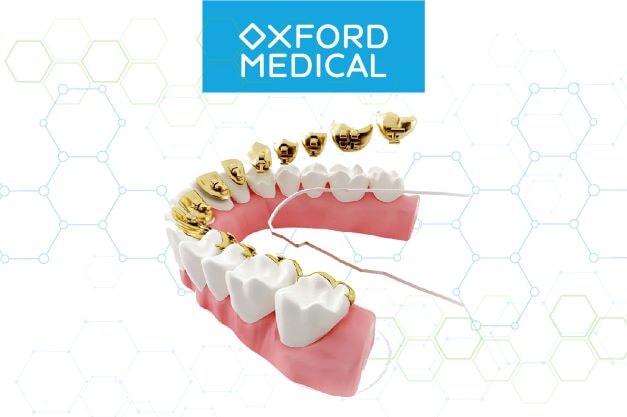 Переваги лінгвальних брекетів