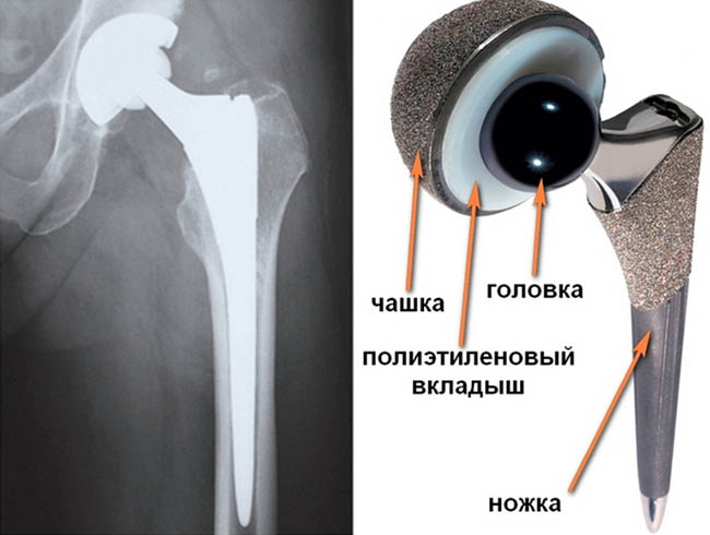 Эндопротезирование тазобедренного сустава в Оксфорд Медикал