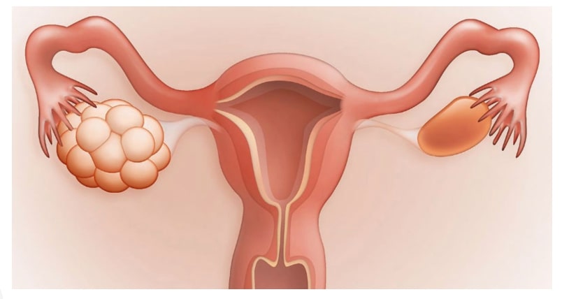 Поликистоз 