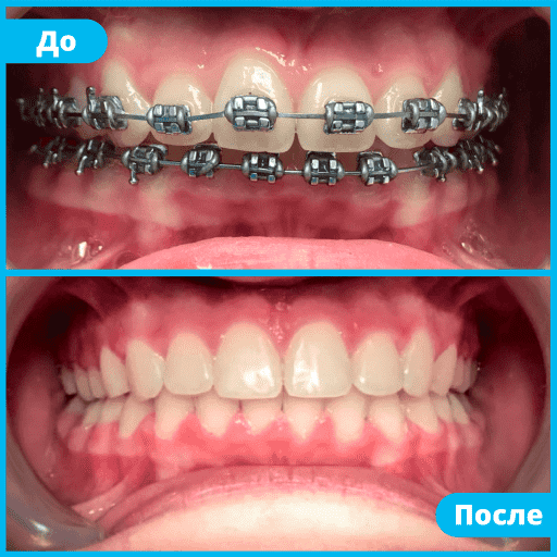 Преимущества брекетов