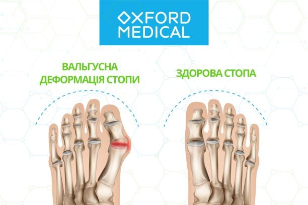 Стадії вальгусної деформації стопи