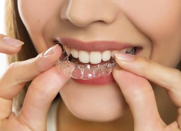 Капи Invisalign