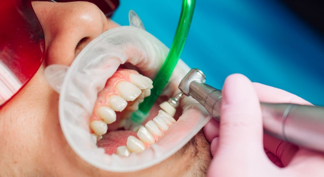 Преимущества удаления зубного камня и налёта в «Оксфорд Медикал»