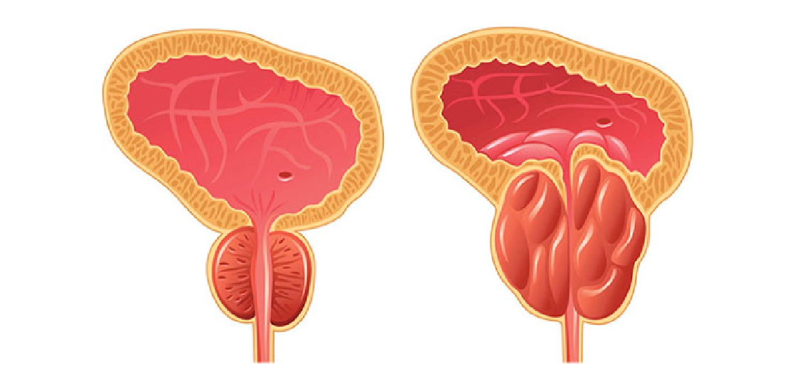 Симптоми гострого везикуліту