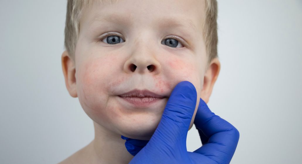 Симптомы скарлатины у детей 