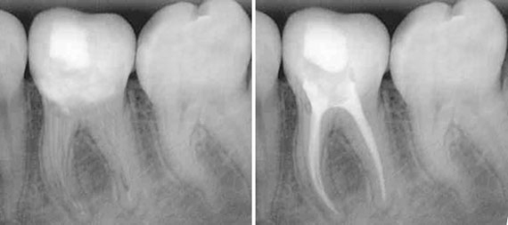 Эндодонтическое лечение в Киеве