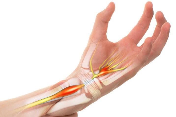 Лікування тунельного синдрому зап'ясткового каналу