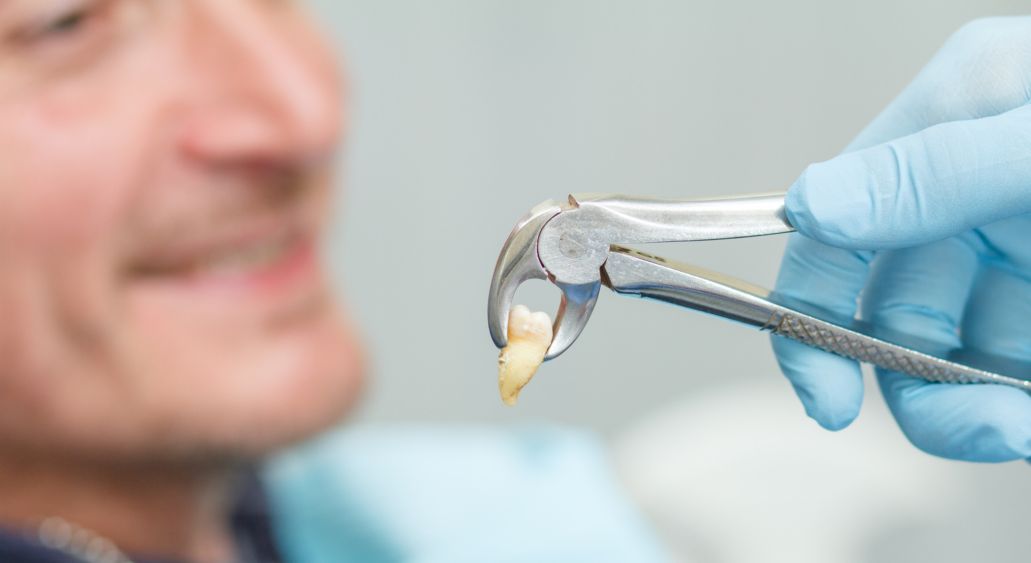 Удаление зуба мудрости, который не прорезался 1