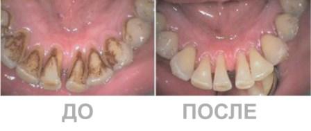 Профилактика заболеваний зубов - до и после