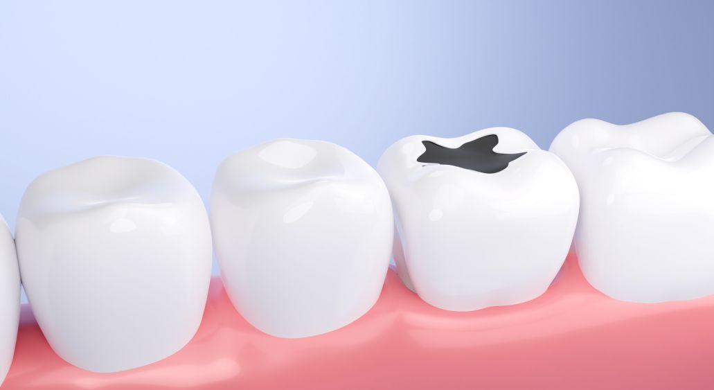 Пломбирование зубов 1