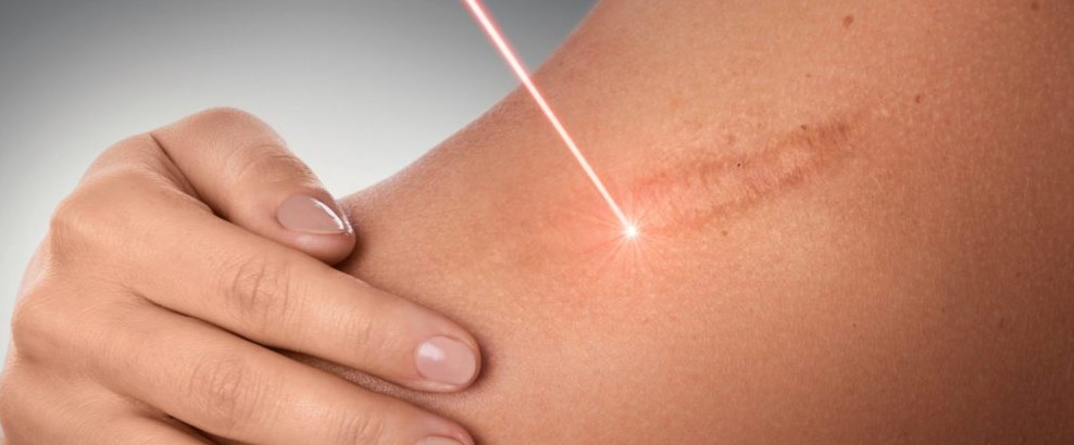  избавиться от шрамов 