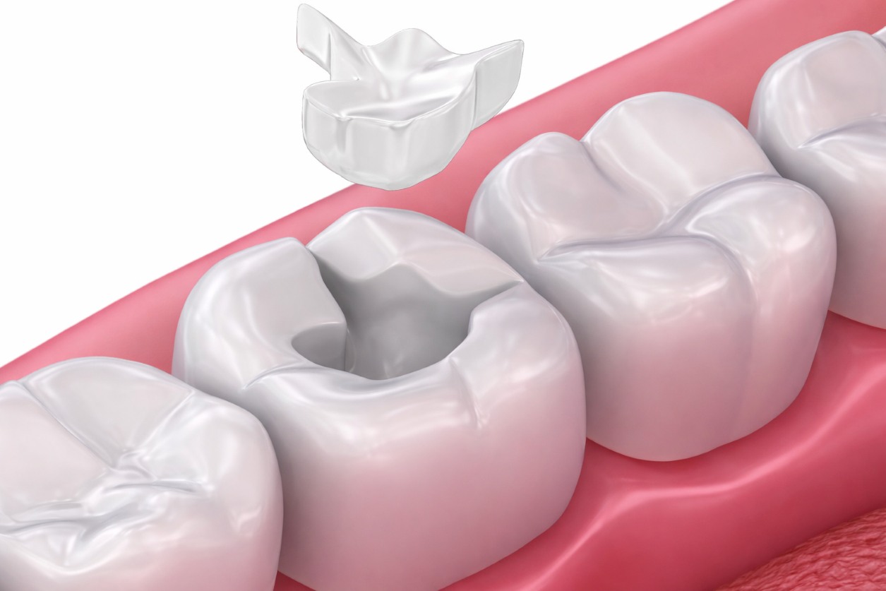 Что такое керамические вкладки на зубы