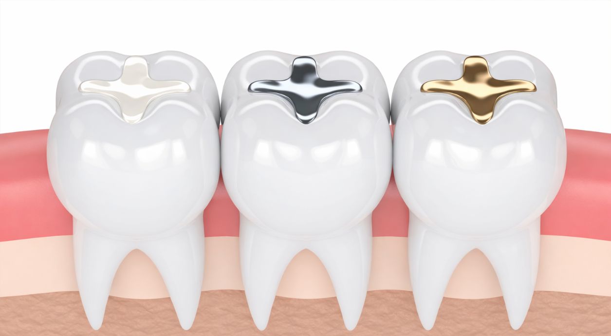 What Is an Inlay in Dentistry?