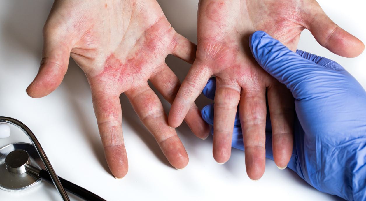 Как отличить псориаз от дерматита