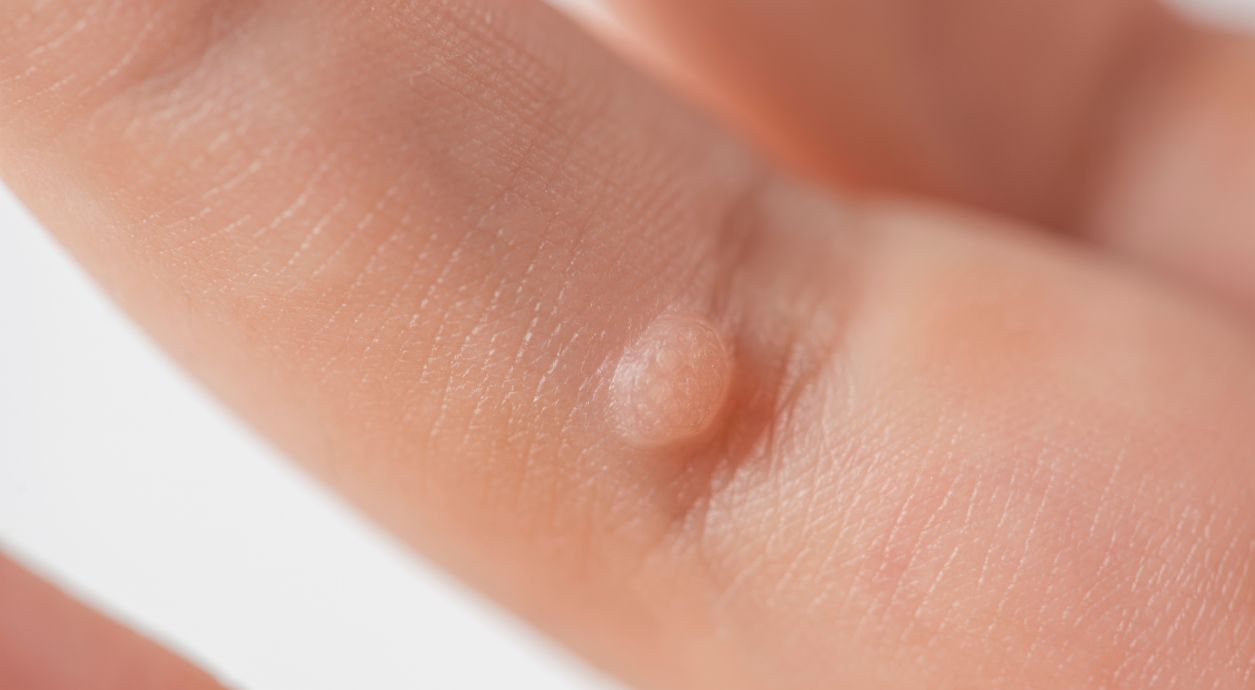 What warts look like