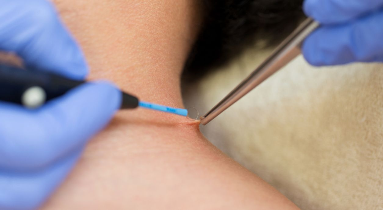 How to get rid of a wart