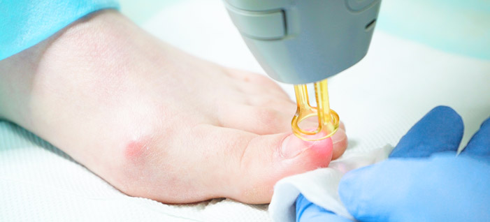 Laser treatment for nail fungus