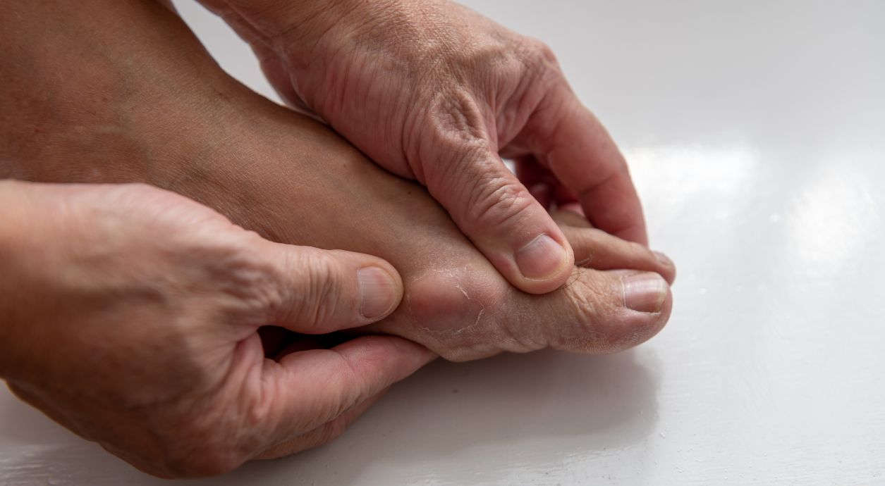 ​​Что такое подагра и как ее лечить