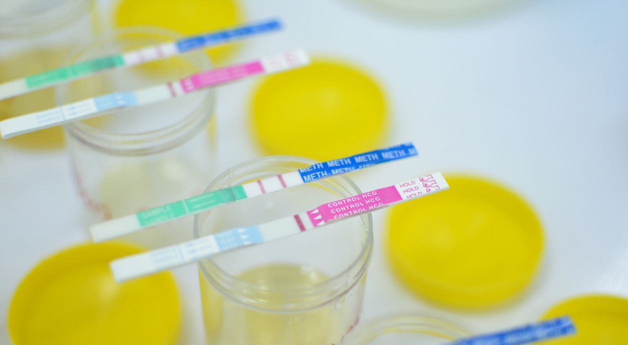 Какие анализы подтверждают белок в моче