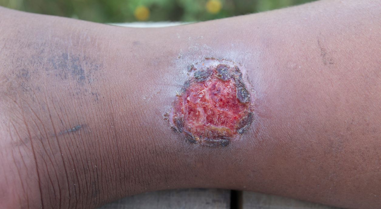 What a trophic ulcer looks like and why it is dangerous