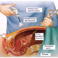 Аднексэктомия (удаление придатков матки при аднексите)
