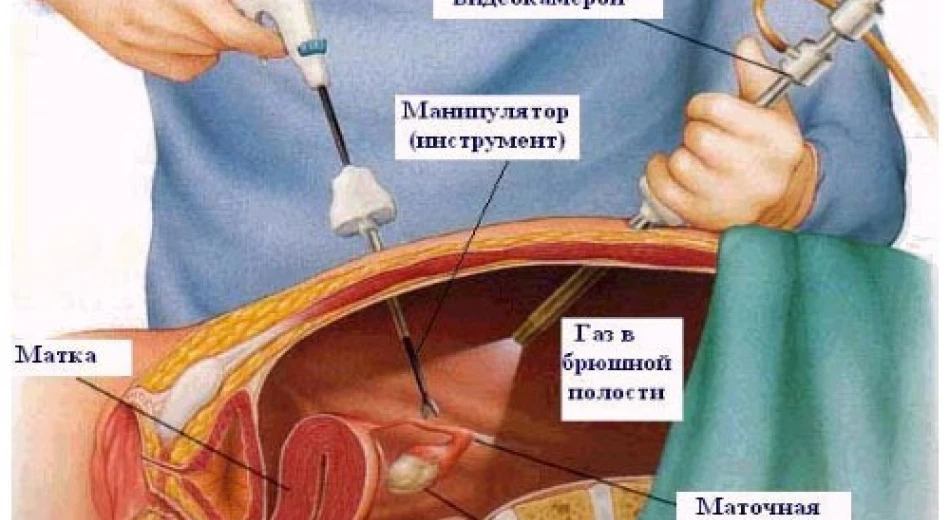 Аднексэктомия (удаление придатков матки при аднексите)