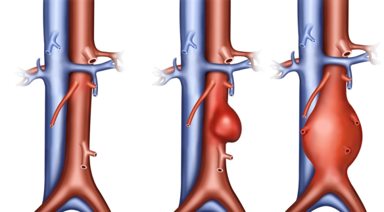 Аневризма аорты: чем опасна и как проявляется?