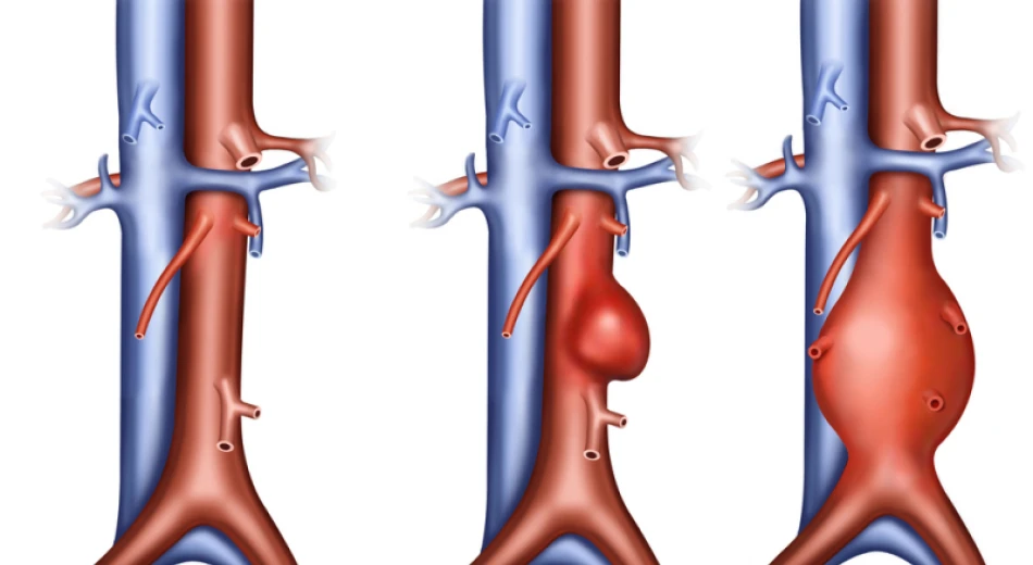 Аневризма аорты: чем опасна и как проявляется?