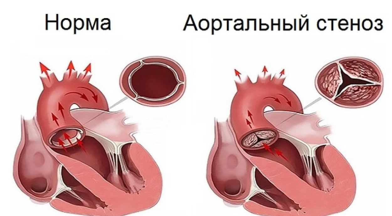 Аортальный стеноз: симптомы и методы лечения