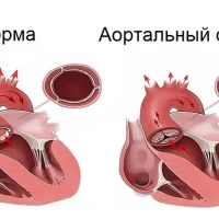Аортальный стеноз: симптомы и методы лечения