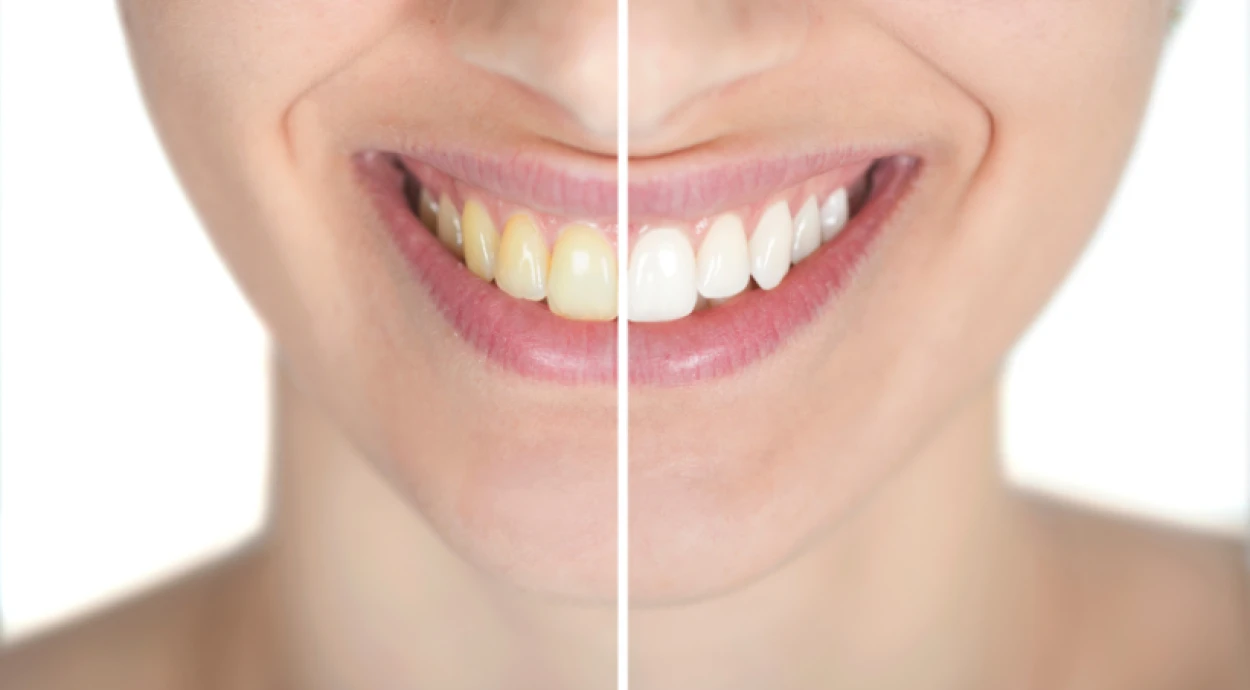 Бережное отбеливание зубов: методы и советы