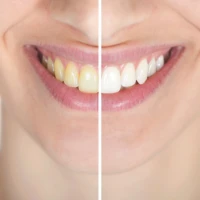 Бережное отбеливание зубов: методы и советы