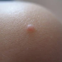 Бородавки: причина появлений и способы устранения