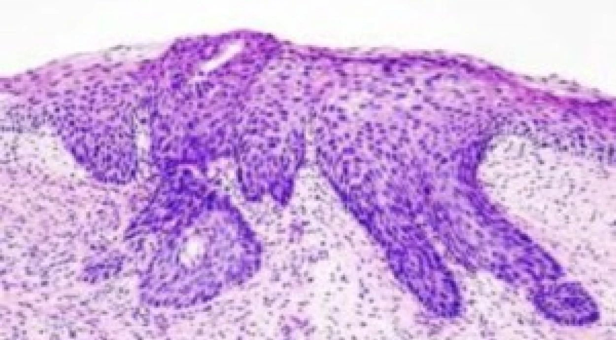 Чем опасна дисплазия шейки матки?